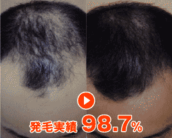 発毛実績98.7%