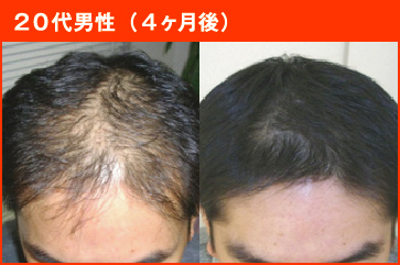 20代男性(4ヶ月後)