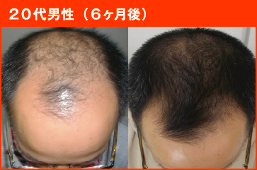20代男性(6ヶ月後)