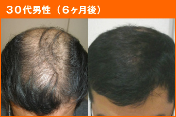 30代男性(6ヶ月後)