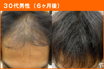 30代男性(6ヶ月後)