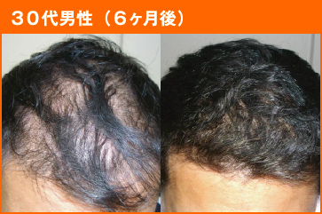 30代男性(6ヶ月後)
