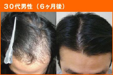 30代男性(6ヶ月後)