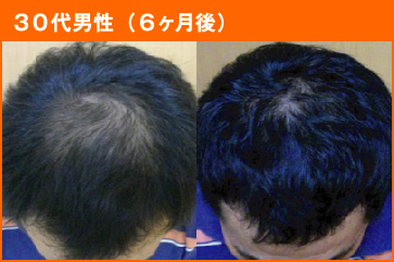 30代男性(6ヶ月後)