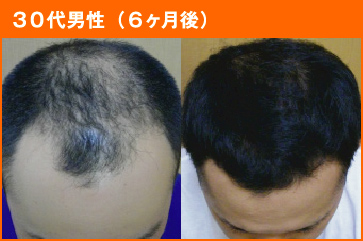30代男性(6ヶ月後)