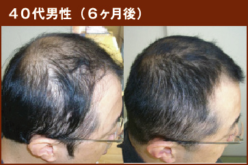 40代男性(6ヶ月後)