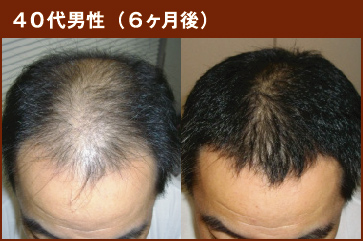 40代男性(6ヶ月後)