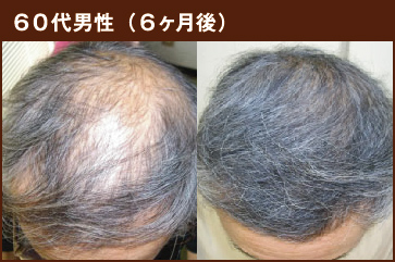 60代男性（6ヶ月後）
