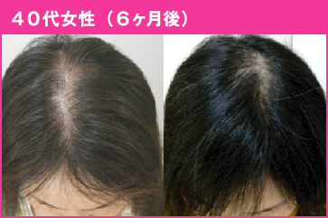40代女性（6ヶ月後）
