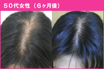 50代女性(6ヶ月後)