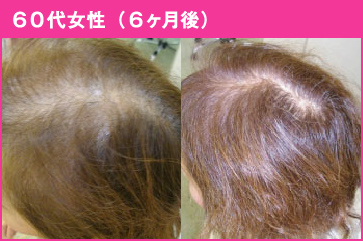 60代女性(6ヶ月後)
